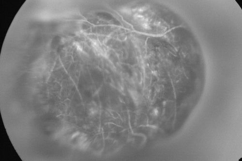 Choroidal Melanoma (Medium) Exudative Retinal Detachment 
87-year-old man noticed a new onset floater a few months ago. OD is 20/40, OS is 20/30
