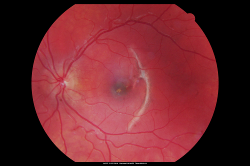 Choroidal Rupture - Hit with Branch - 11 Year Old Boy
 11-year-old had a choroidal rupture in the left eye with a macular hemorrhage 4 months ago. He had a rupture globe repair. Vision has improved some. VISUAL ACUITY:  OS 20/200.
1 year later Vision was 20/30
