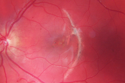 Choroidal Rupture - Hit with Branch - 11 Year Old Boy
 11-year-old had a choroidal rupture in the left eye with a macular hemorrhage 4 months ago. He had a rupture globe repair. Vision has improved some. VISUAL ACUITY:  OS 20/200.
1 year later Vision was 20/30
