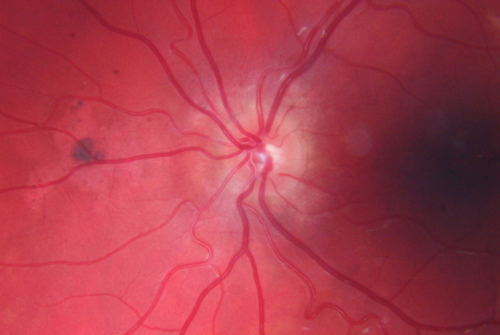Choroidal Rupture - Hit with Branch - 11 Year Old Boy
 11-year-old had a choroidal rupture in the left eye with a macular hemorrhage 4 months ago. He had a rupture globe repair. Vision has improved some. VISUAL ACUITY:  OS 20/200.
1 year later Vision was 20/30

