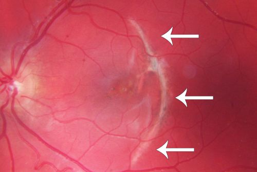 Choroidal Rupture - Hit with Branch - 11 Year Old Boy
  11-year-old had a choroidal rupture in the left eye with a macular hemorrhage 4 months ago. He had a rupture globe repair. Vision has improved some. VISUAL ACUITY:  OS 20/200.

1 year later Vision was 20/30
