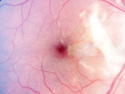 Choroidal Rupture - 13 year old - 3 months following injury to eye with aluminum foil ball corneal laceration 
13-year-old 3 months post injury to right eye with corneal laceration and cryo to a retinal tear on July 27th and then six clock hours away laser to a retinal tear on October 20th.  His vision is a little better in the eye.

VISUAL ACUITY:  Vision OD is 20/120.
