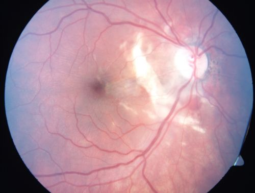 Choroidal Rupture - 13 year old - 3 months following injury to eye with aluminum foil ball corneal laceration 
13-year-old 3 months post injury to right eye with corneal laceration and cryo to a retinal tear on July 27th and then six clock hours away laser to a retinal tear on October 20th.  His vision is a little better in the eye.

VISUAL ACUITY:  Vision OD is 20/120.
