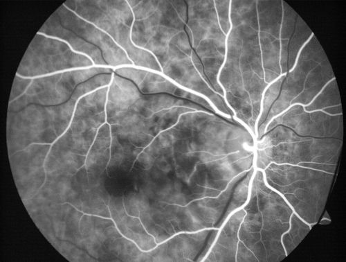 Choroidal Rupture - 13 year old - 3 months following injury to eye with aluminum foil ball corneal laceration 
13-year-old 3 months post injury to right eye with corneal laceration and cryo to a retinal tear on July 27th and then six clock hours away laser to a retinal tear on October 20th.  His vision is a little better in the eye.

VISUAL ACUITY:  Vision OD is 20/120.
