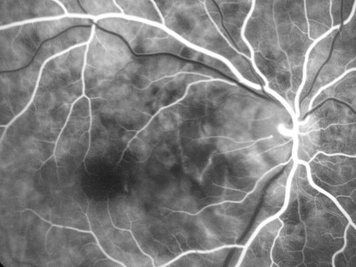 Choroidal Rupture - 13 year old - 3 months following injury to eye with aluminum foil ball corneal laceration 
13-year-old 3 months post injury to right eye with corneal laceration and cryo to a retinal tear on July 27th and then six clock hours away laser to a retinal tear on October 20th.  His vision is a little better in the eye.

VISUAL ACUITY:  Vision OD is 20/120.
