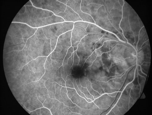 Choroidal Rupture - 13 year old - 3 months following injury to eye with aluminum foil ball corneal laceration 
13-year-old 3 months post injury to right eye with corneal laceration and cryo to a retinal tear on July 27th and then six clock hours away laser to a retinal tear on October 20th.  His vision is a little better in the eye.

VISUAL ACUITY:  Vision OD is 20/120.

