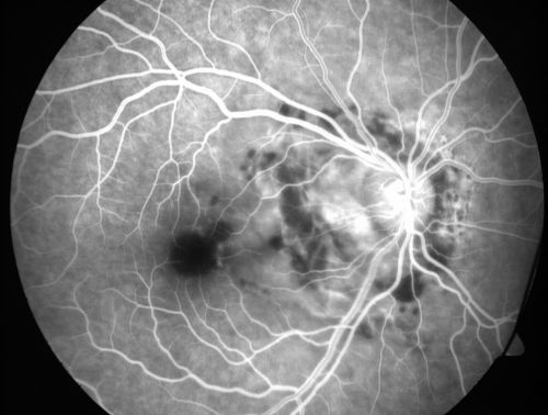 Choroidal Rupture - 13 year old - 3 months following injury to eye with aluminum foil ball corneal laceration 
13-year-old 3 months post injury to right eye with corneal laceration and cryo to a retinal tear on July 27th and then six clock hours away laser to a retinal tear on October 20th.  His vision is a little better in the eye.

VISUAL ACUITY:  Vision OD is 20/120.
