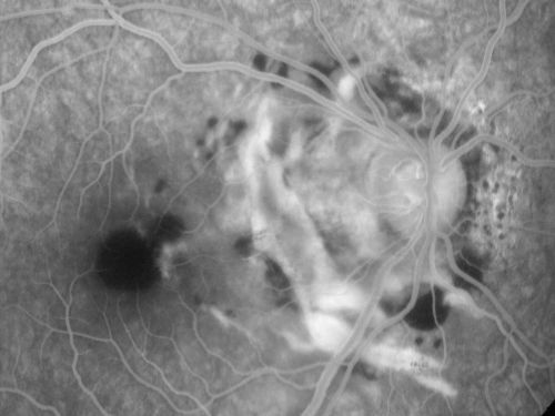 Choroidal Rupture - 13 year old - 3 months following injury to eye with aluminum foil ball corneal laceration 
13-year-old 3 months post injury to right eye with corneal laceration and cryo to a retinal tear on July 27th and then six clock hours away laser to a retinal tear on October 20th.  His vision is a little better in the eye.

VISUAL ACUITY:  Vision OD is 20/120.
