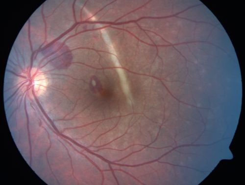 Choroidal Rupture and small Hemorrhage - Assault
34 year old man. The patient reports he was assaulted by a couple of adolescents near downtown St. Petersburg about forty-eight hours ago.   He reports the pain in the left eye has significantly improved, but his vision is a little fuzzy and he sees some floaters in the left eye.  20/125 OD, 20/20 OS.  Pinhole improves in the right eye to 20/50.  IOP:  15 OD, 13 OS.
SLIT LAMP EXAMINATION:  Biomicroscopy reveals 3+ pupillary reaction OD, 2+ OS with no afferent pupillary defect.  EXTENDED OPHTHALMOSCOPY:  Extended funduscopy with Volk 90-diopter lens and fundus drawings of both eyes reveal a clear view with no posterior vitreous separation.  C/D ratio is 0.2.  There is no vitreous debris or hemorrhage.  Large retinal vessels and macula are healthy.  The retinal periphery, inspected with scleral depression for 360Â° shows no retinal tears, breaks, or detachments.

Keywords: choroidal rupture;scar;hemorrhage;trauma
