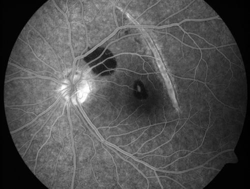Choroidal Rupture and small Hemorrhage - Assault
34 year old man. The patient reports he was assaulted by a couple of adolescents near downtown St. Petersburg about forty-eight hours ago.   He reports the pain in the left eye has significantly improved, but his vision is a little fuzzy and he sees some floaters in the left eye.  20/125 OD, 20/20 OS.  Pinhole improves in the right eye to 20/50.  IOP:  15 OD, 13 OS.
SLIT LAMP EXAMINATION:  Biomicroscopy reveals 3+ pupillary reaction OD, 2+ OS with no afferent pupillary defect.  EXTENDED OPHTHALMOSCOPY:  Extended funduscopy with Volk 90-diopter lens and fundus drawings of both eyes reveal a clear view with no posterior vitreous separation.  C/D ratio is 0.2.  There is no vitreous debris or hemorrhage.  Large retinal vessels and macula are healthy.  The retinal periphery, inspected with scleral depression for 360Â° shows no retinal tears, breaks, or detachments.

Keywords: choroidal rupture;scar;hemorrhage;trauma