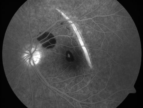 Choroidal Rupture and small Hemorrhage - Assault
34 year old man. The patient reports he was assaulted by a couple of adolescents near downtown St. Petersburg about forty-eight hours ago.   He reports the pain in the left eye has significantly improved, but his vision is a little fuzzy and he sees some floaters in the left eye.  20/125 OD, 20/20 OS.  Pinhole improves in the right eye to 20/50.  IOP:  15 OD, 13 OS.
SLIT LAMP EXAMINATION:  Biomicroscopy reveals 3+ pupillary reaction OD, 2+ OS with no afferent pupillary defect.  EXTENDED OPHTHALMOSCOPY:  Extended funduscopy with Volk 90-diopter lens and fundus drawings of both eyes reveal a clear view with no posterior vitreous separation.  C/D ratio is 0.2.  There is no vitreous debris or hemorrhage.  Large retinal vessels and macula are healthy.  The retinal periphery, inspected with scleral depression for 360Â° shows no retinal tears, breaks, or detachments.

Keywords: choroidal rupture;scar;hemorrhage;trauma
