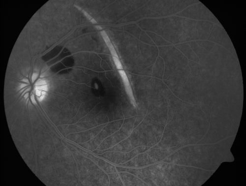 Choroidal Rupture and small Hemorrhage - Assault
34 year old man. The patient reports he was assaulted by a couple of adolescents near downtown St. Petersburg about forty-eight hours ago.   He reports the pain in the left eye has significantly improved, but his vision is a little fuzzy and he sees some floaters in the left eye.  20/125 OD, 20/20 OS.  Pinhole improves in the right eye to 20/50.  IOP:  15 OD, 13 OS.
SLIT LAMP EXAMINATION:  Biomicroscopy reveals 3+ pupillary reaction OD, 2+ OS with no afferent pupillary defect.  EXTENDED OPHTHALMOSCOPY:  Extended funduscopy with Volk 90-diopter lens and fundus drawings of both eyes reveal a clear view with no posterior vitreous separation.  C/D ratio is 0.2.  There is no vitreous debris or hemorrhage.  Large retinal vessels and macula are healthy.  The retinal periphery, inspected with scleral depression for 360Â° shows no retinal tears, breaks, or detachments.

Võtmesõnad: choroidal rupture;scar;hemorrhage;trauma