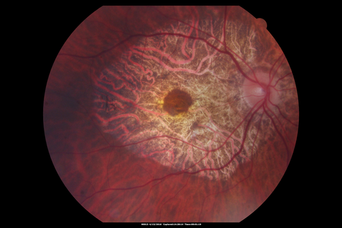 Central Areolar Choroidal Dystrophy
Vision loss from early 60's.  This 78 year old woman has choroidal atrophy centrally.
