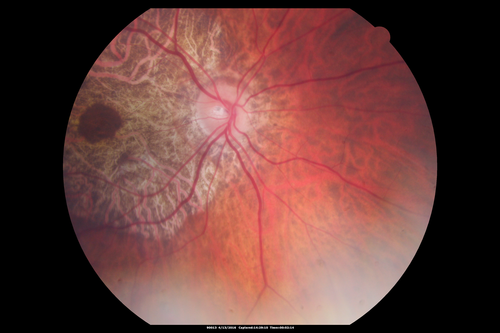 Central Areolar Choroidal Dystrophy
Vision loss from early 60's.  This 78 year old woman has choroidal atrophy centrally.
