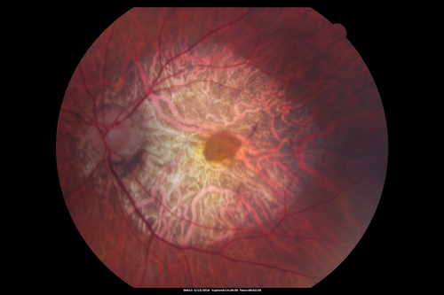 Central Areolar Choroidal Dystrophy
Vision loss from early 60's.  This 78 year old woman has choroidal atrophy centrally.
