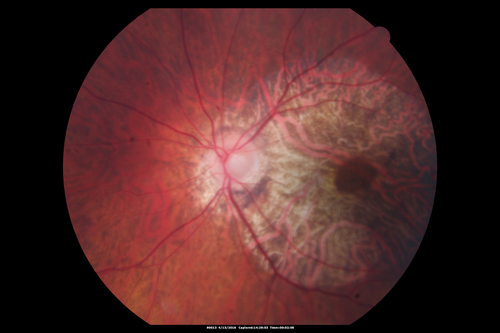 Central Areolar Choroidal Dystrophy
Vision loss from early 60's.  This 78 year old woman has choroidal atrophy centrally.
