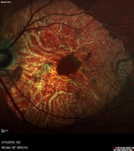 Central Areolar Choroidal Dystrophy
Vision loss from early 60's.  This 78 year old woman has choroidal atrophy centrally.
