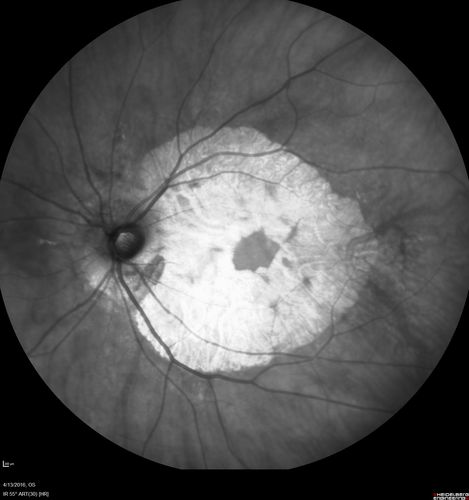 Central Areolar Choroidal Dystrophy
Vision loss from early 60's.  This 78 year old woman has choroidal atrophy centrally.
