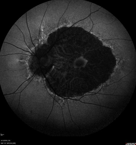Central Areolar Choroidal Dystrophy
Vision loss from early 60's.  This 78 year old woman has choroidal atrophy centrally.
