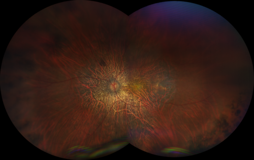 Choroideremia - Adult
69 year old man with no family history of choroideremia and gradual vision loss in both eyes.  VVA 20/125 OD; 20/63 OS
