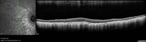 Choroideremia - Adult
69 year old man with no family history of choroideremia and gradual vision loss in both eyes.  VVA 20/125 OD; 20/63 OS
