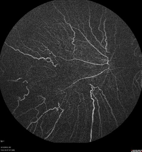 Choroideremia - Adult
69 year old man with no family history of choroideremia and gradual vision loss in both eyes.  VVA 20/125 OD; 20/63 OS

