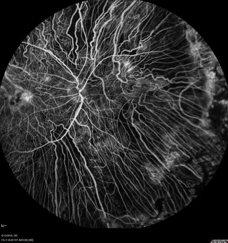 Choroideremia - Adult
69 year old man with no family history of choroideremia and gradual vision loss in both eyes.  VVA 20/125 OD; 20/63 OS
