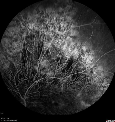 Choroideremia - Adult
69 year old man with no family history of choroideremia and gradual vision loss in both eyes.  VVA 20/125 OD; 20/63 OS
