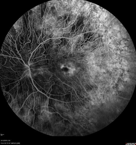 Choroideremia - Adult
69 year old man with no family history of choroideremia and gradual vision loss in both eyes.  VVA 20/125 OD; 20/63 OS
