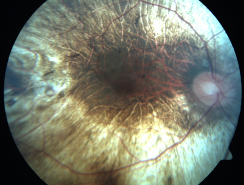 Choroideremia - Complete CHM gene deletion
Vision loss since age 20 - now age 36 VA 20/160 (about) OU
