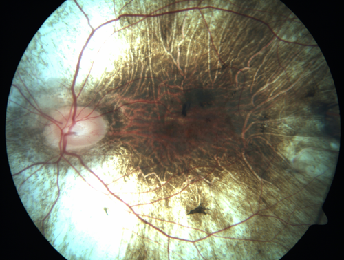 Choroideremia - Complete CHM gene deletion
Vision loss since age 20 - now age 36 VA 20/160 (about) OU
