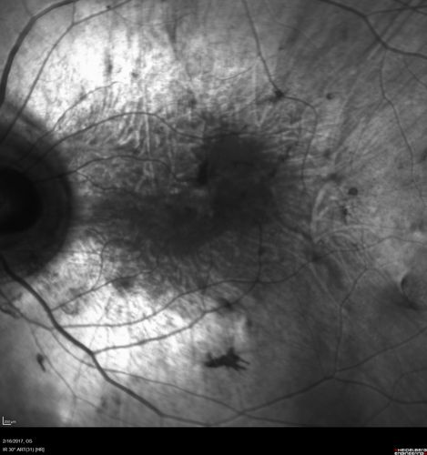 Choroideremia - Complete CHM gene deletion
Vision loss since age 20 - now age 36 VA 20/160 (about) OU
