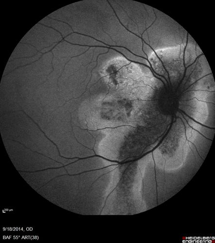 Chronic Central Serous Chorioretinopathy Both Eyes
60 year old man with 20 year history of chronic CSR. He has had laser and PDT in the past.  The left eye has been 20/100 for decades.  The right eye is now declining.  Was 20/32 and is down to 20/50.  There is chronic low grade subretinal fluid away from the center in the right eye.  (focal laser in the right eye in 2005, left eye 2001 at BPEI).  Refampin tried in 2012, Aldactone in 2013.  PDT in 204 and 2017  Images are from 2017
