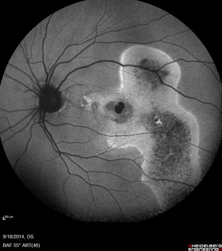 Chronic Central Serous Chorioretinopathy Both Eyes
60 year old man with 20 year history of chronic CSR. He has had laser and PDT in the past.  The left eye has been 20/100 for decades.  The right eye is now declining.  Was 20/32 and is down to 20/50.  There is chronic low grade subretinal fluid away from the center in the right eye.  (focal laser in the right eye in 2005, left eye 2001 at BPEI).  Refampin tried in 2012, Aldactone in 2013.  PDT in 204 and 2017  Images are from 2017

