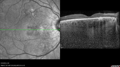Chronic Central Serous Chorioretinopathy Both Eyes
60 year old man with 20 year history of chronic CSR. He has had laser and PDT in the past.  The left eye has been 20/100 for decades.  The right eye is now declining.  Was 20/32 and is down to 20/50.  There is chronic low grade subretinal fluid away from the center in the right eye.  (focal laser in the right eye in 2005, left eye 2001 at BPEI).  Refampin tried in 2012, Aldactone in 2013.  PDT in 204 and 2017  Images are from 2017
