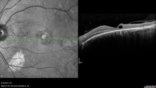 Chronic Central Serous Chorioretinopathy Both Eyes
60 year old man with 20 year history of chronic CSR. He has had laser and PDT in the past.  The left eye has been 20/100 for decades.  The right eye is now declining.  Was 20/32 and is down to 20/50.  There is chronic low grade subretinal fluid away from the center in the right eye.  (focal laser in the right eye in 2005, left eye 2001 at BPEI).  Refampin tried in 2012, Aldactone in 2013.  PDT in 204 and 2017  Images are from 2017

