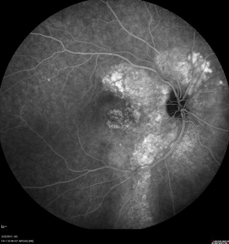 Chronic Central Serous Chorioretinopathy Both Eyes
60 year old man with 20 year history of chronic CSR. He has had laser and PDT in the past.  The left eye has been 20/100 for decades.  The right eye is now declining.  Was 20/32 and is down to 20/50.  There is chronic low grade subretinal fluid away from the center in the right eye.  (focal laser in the right eye in 2005, left eye 2001 at BPEI).  Refampin tried in 2012, Aldactone in 2013.  PDT in 204 and 2017  Images are from 2017
