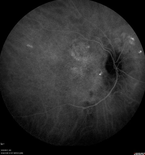 Chronic Central Serous Chorioretinopathy Both Eyes
60 year old man with 20 year history of chronic CSR. He has had laser and PDT in the past.  The left eye has been 20/100 for decades.  The right eye is now declining.  Was 20/32 and is down to 20/50.  There is chronic low grade subretinal fluid away from the center in the right eye.  (focal laser in the right eye in 2005, left eye 2001 at BPEI).  Refampin tried in 2012, Aldactone in 2013.  PDT in 204 and 2017  Images are from 2017
