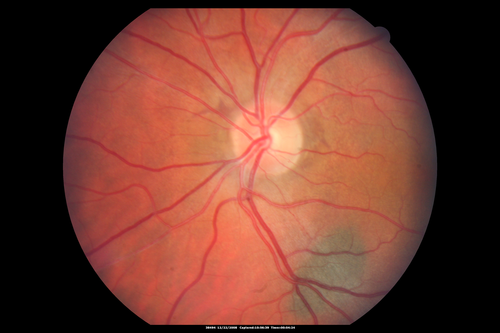 Chronic Central Serous Chorioretinopathy Both Eyes
60 year old man with 20 year history of chronic CSR. He has had laser and PDT in the past.  The left eye has been 20/100 for decades.  The right eye is now declining.  Was 20/32 and is down to 20/50.  There is chronic low grade subretinal fluid away from the center in the right eye.  (focal laser in the right eye in 2005, left eye 2001 at BPEI).  Refampin tried in 2012, Aldactone in 2013.  PDT in 204 and 2017  Images are from 2017
