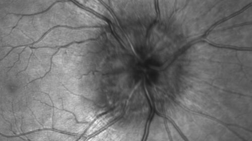 Congenital Hydrocephalus - 21 year old - Papilledema
21 year old man The patient had a v-p shunt removed in January 2017.  He has not had escalating headaches.  The shunt was put in in 2015.  He was born with hydrocephalus.  The shunt was possibly overdraining for 5 years so there were problems with slipped ventricles and low CSR pressure.  The pressure was checked today and it was perfect.  There is still a bulb so the CSF pressure can be checked.  There was eye examination in November showing possible papilledema.  
VA OD: sc20/40+2 NscJ5
VA OS: sc20/32+2 NscJ1
