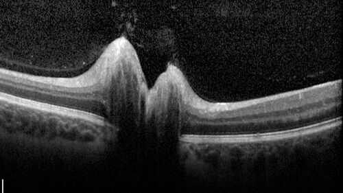 Congenital Hydrocephalus - 21 year old - Papilledema
21 year old man The patient had a v-p shunt removed in January 2017.  He has not had escalating headaches.  The shunt was put in in 2015.  He was born with hydrocephalus.  The shunt was possibly overdraining for 5 years so there were problems with slipped ventricles and low CSR pressure.  The pressure was checked today and it was perfect.  There is still a bulb so the CSF pressure can be checked.  There was eye examination in November showing possible papilledema.  
VA OD: sc20/40+2 NscJ5
VA OS: sc20/32+2 NscJ1
