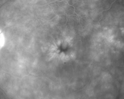Chronic Pseudophakic Cystoid Macular Edema in a Patient with Diabetes
74-year-old woman has chronic cystoid macular edema in the left eye.  She has had vision loss intermittently in that eye for 2 years, the right eye, unfortunately, lost vision from a central retinal vein occlusion in 6 years ago.
