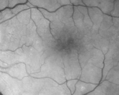 Chronic Pseudophakic Cystoid Macular Edema in a Patient with Diabetes
74-year-old woman has chronic cystoid macular edema in the left eye.  She has had vision loss intermittently in that eye for 2 years, the right eye, unfortunately, lost vision from a central retinal vein occlusion in 6 years ago.
