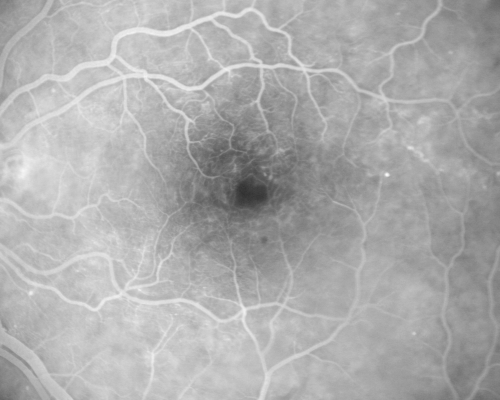 Chronic Pseudophakic Cystoid Macular Edema in a Patient with Diabetes
74-year-old woman has chronic cystoid macular edema in the left eye.  She has had vision loss intermittently in that eye for 2 years, the right eye, unfortunately, lost vision from a central retinal vein occlusion in 6 years ago.

