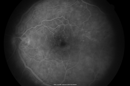 Chronic Pseudophakic Cystoid Macular Edema in a Patient with Diabetes
74-year-old woman has chronic cystoid macular edema in the left eye.  She has had vision loss intermittently in that eye for 2 years, the right eye, unfortunately, lost vision from a central retinal vein occlusion in 6 years ago.
