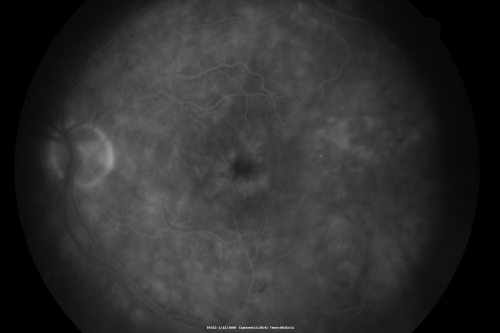 Chronic Pseudophakic Cystoid Macular Edema in a Patient with Diabetes
74-year-old woman has chronic cystoid macular edema in the left eye.  She has had vision loss intermittently in that eye for 2 years, the right eye, unfortunately, lost vision from a central retinal vein occlusion in 6 years ago.
