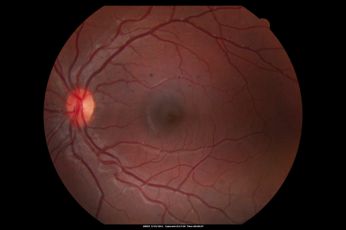 CHRPE - Gardner Syndrome - FAMILIAL COLORECTAL POLYPOSIS - 11 year old female
11-year-old child with CHRPE OS has six undescended adult teeth and also she has had a cyst removed from her arm pit and she has three more in her arm pit and one on her face and she is seeing a dermatologist for that in the near future.   The mother reports no health problems, however, the patientâ€™s grandmother does have a history of intestinal polyps, as does the patientâ€™s grandmotherâ€™s brothers son.  
