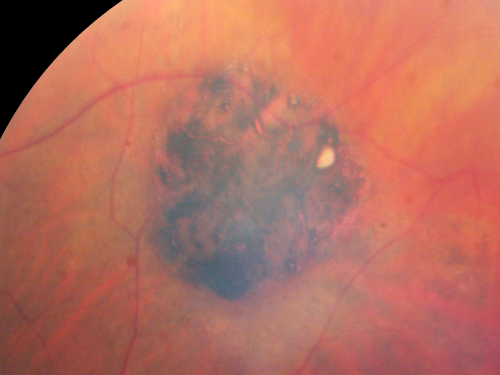CHRPE - Congenital Hypertrophy of the Pigment Epithelium - Peripheral
55-year-old woman OD 20/30,  OS 20/25
