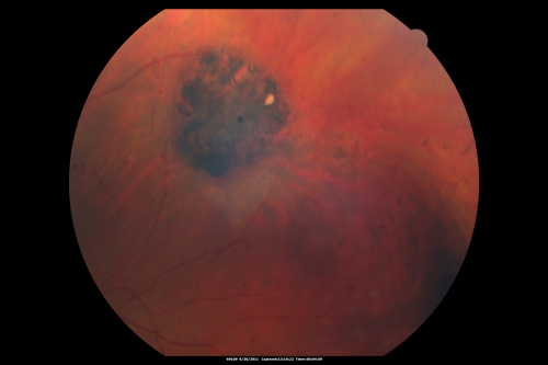 CHRPE - Congenital Hypertrophy of the Pigment Epithelium - Peripheral
55-year-old woman OD 20/30,  OS 20/25
