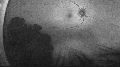 Congenital hypertrophy of the retinal pigment epithelium CHRPE
FAF, Optos Photo and FA
